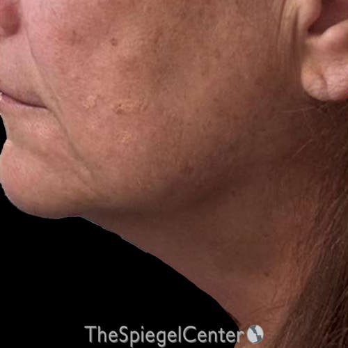 Junera (EraLift) Before & After Gallery - Patient 344086 - Image 2
