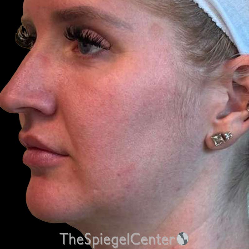Junera (EraLift) Before & After Gallery - Patient 624672 - Image 3