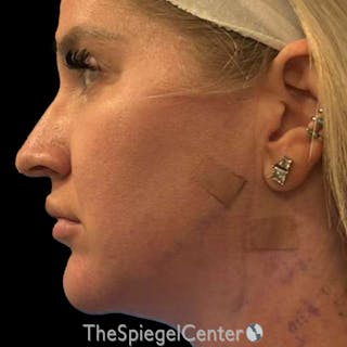 Junera (EraLift) Before & After Gallery - Patient 624672 - Image 4