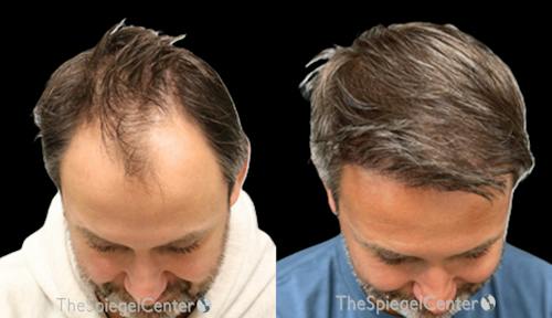 Hair Restoration Before & After Gallery - Patient 889583 - Image 1