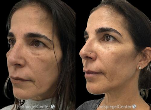 IPL / Intense Pulse Light Before & After Gallery - Patient 255062 - Image 1