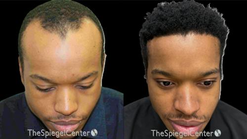 Hair Restoration Before & After Gallery - Patient 402677 - Image 1