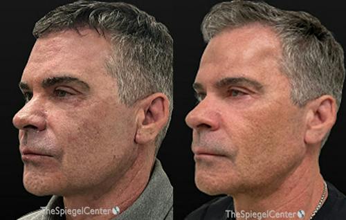 IPL / Intense Pulse Light Before & After Gallery - Patient 296331 - Image 1