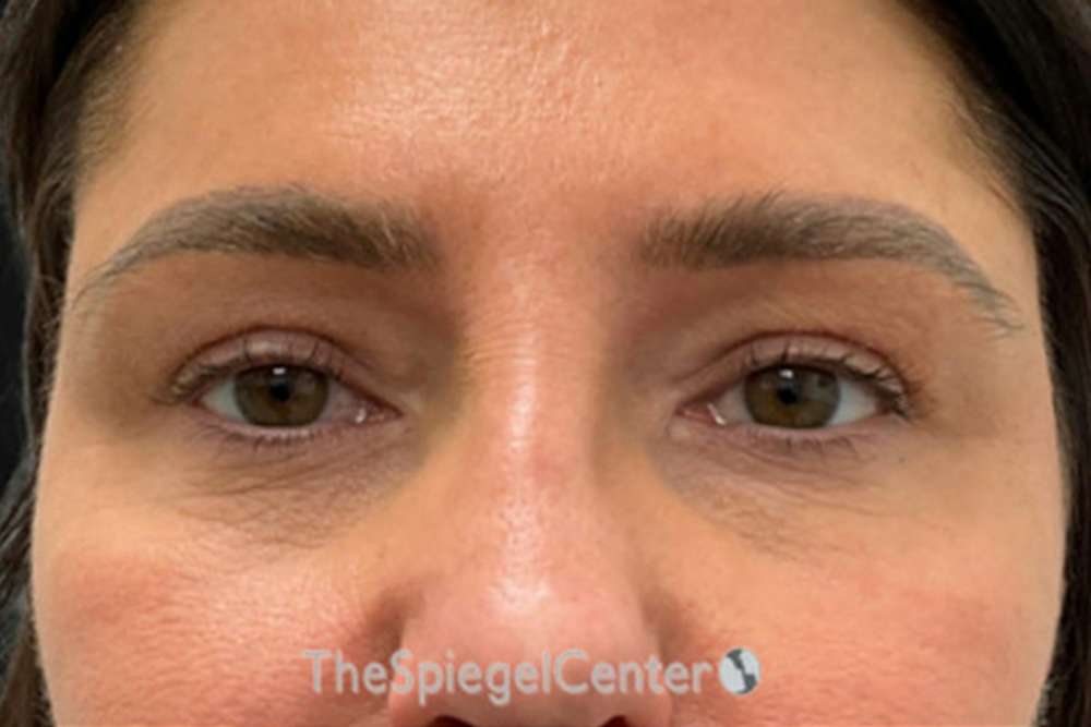 Dermal Fillers