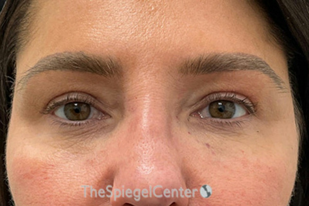 Dermal Fillers