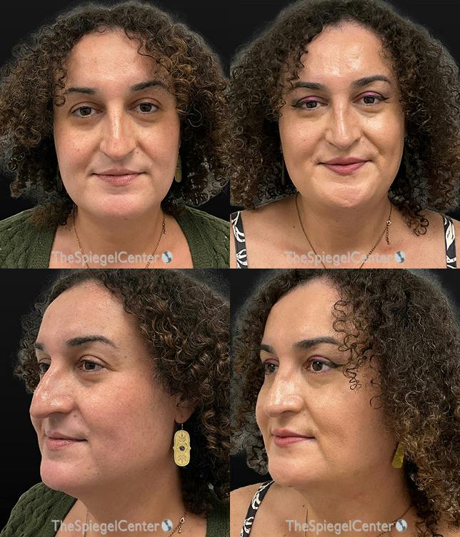 FFS Before & After Gallery - Patient 311428 - Image 1