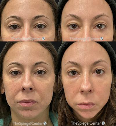 Temple Filler Before & After Gallery - Patient 964062 - Image 1
