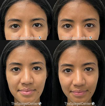 Temple Filler Before & After Gallery - Patient 344248 - Image 1