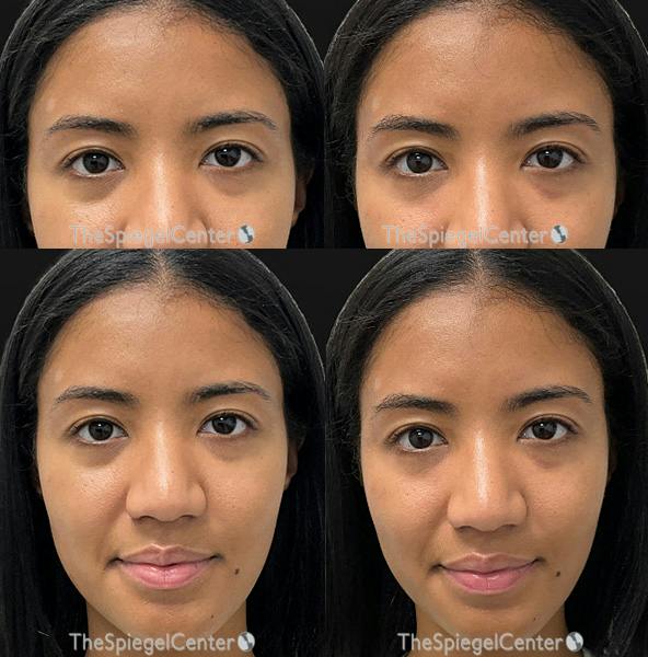 Temple Filler Before & After Gallery - Patient 344248 - Image 1