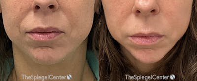 DAO Botulinum Before & After Gallery - Patient 741309 - Image 1