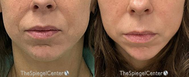 DAO Botulinum Before & After Gallery - Patient 741309 - Image 1