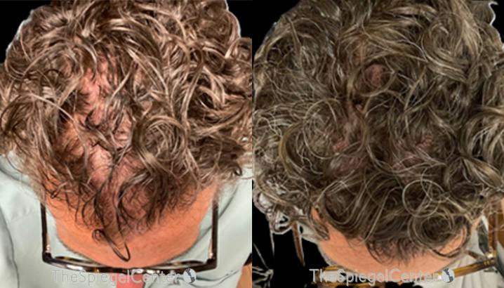Hair Restoration Before & After Gallery - Patient 336540 - Image 1