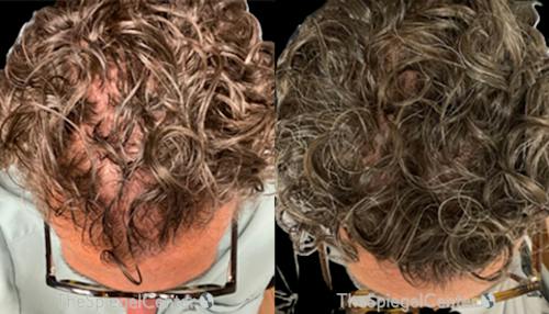 Hair Restoration Before & After Gallery - Patient 336540 - Image 1