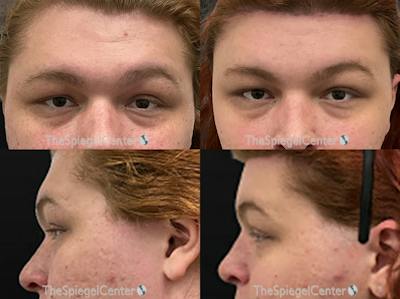 Forehead Contouring Before & After Gallery - Patient 176384 - Image 1