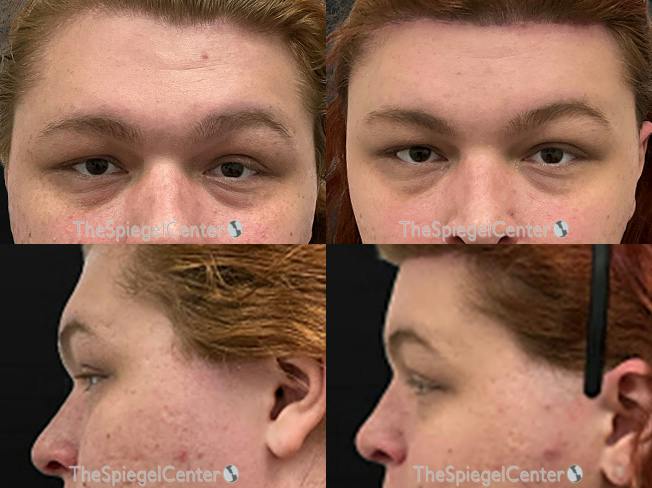 Forehead Contouring Before & After Gallery - Patient 176384 - Image 1