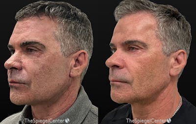 Morpheus8 Before & After Gallery - Patient 613146 - Image 1