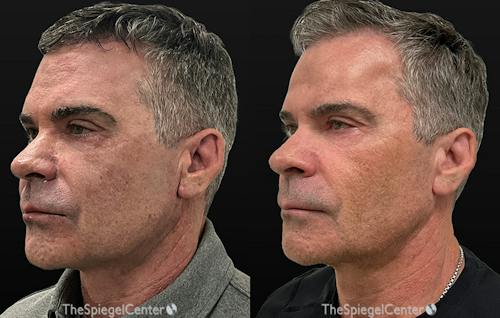 Morpheus8 Before & After Gallery - Patient 613146 - Image 1
