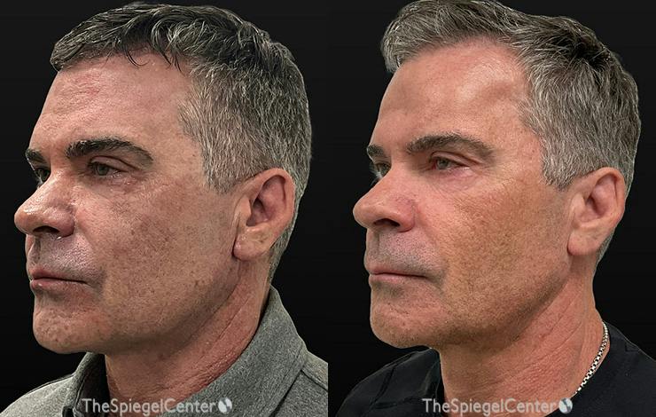 Morpheus8 Before & After Gallery - Patient 613146 - Image 1