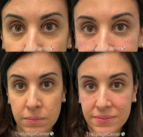 Temple Filler Before & After Gallery - Patient 795070 - Image 1