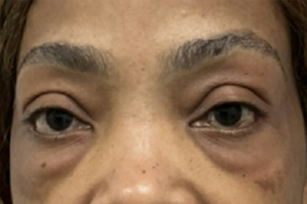 Dermal Fillers in Boston Before and After Photos