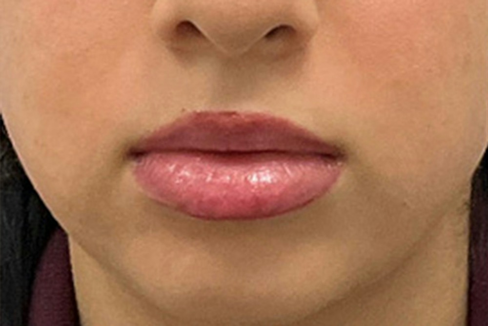 Dermal Fillers