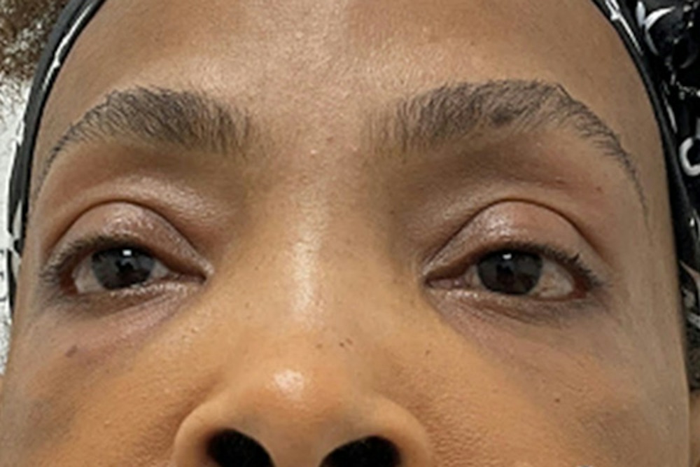 Dermal Fillers in Boston Before and After Photos