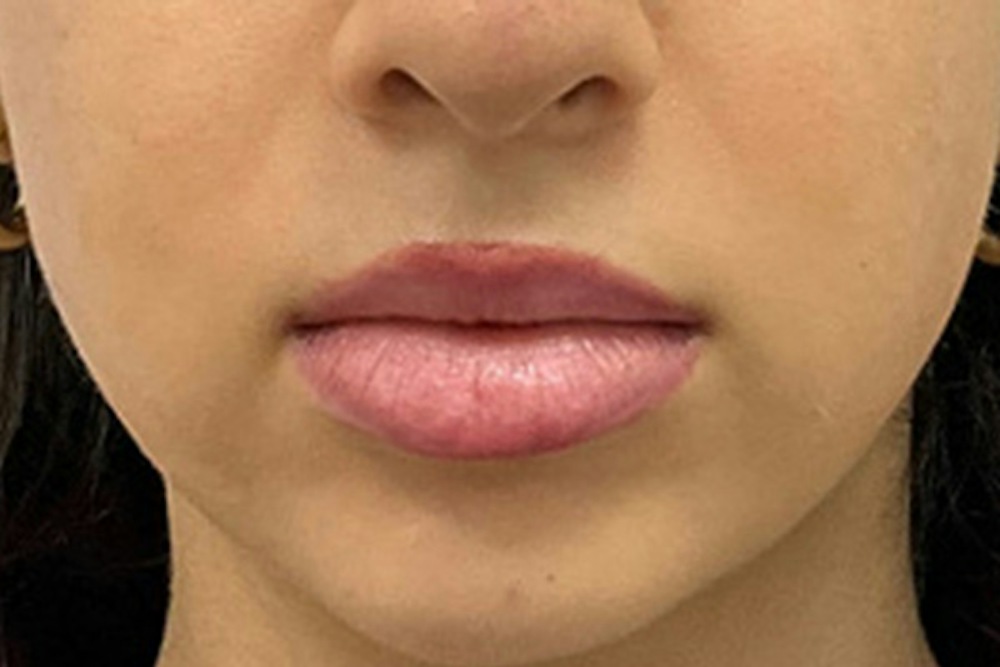 Dermal Fillers