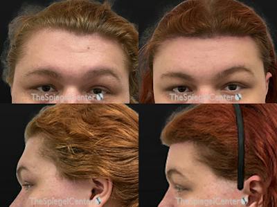 Forehead Contouring Before & After Gallery - Patient 176384 - Image 1