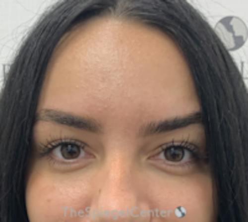 Botox Brow Lift Before & After Gallery - Patient 344637 - Image 2