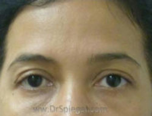 Botox Brow Lift Before & After Gallery - Patient 392185 - Image 1
