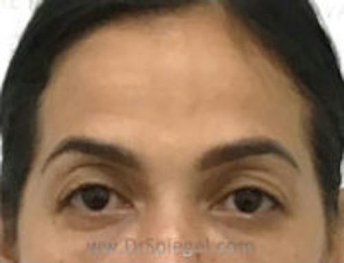 Botox Brow Lift Before & After Gallery - Patient 392185 - Image 2