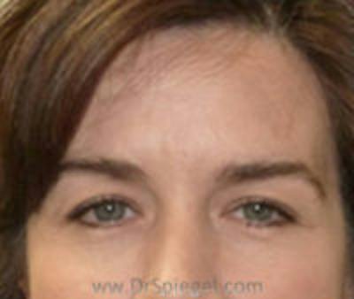 Botox Brow Lift Before & After Gallery - Patient 300595 - Image 1