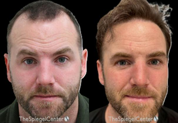 Hair Restoration Before & After Gallery - Patient 259065 - Image 1