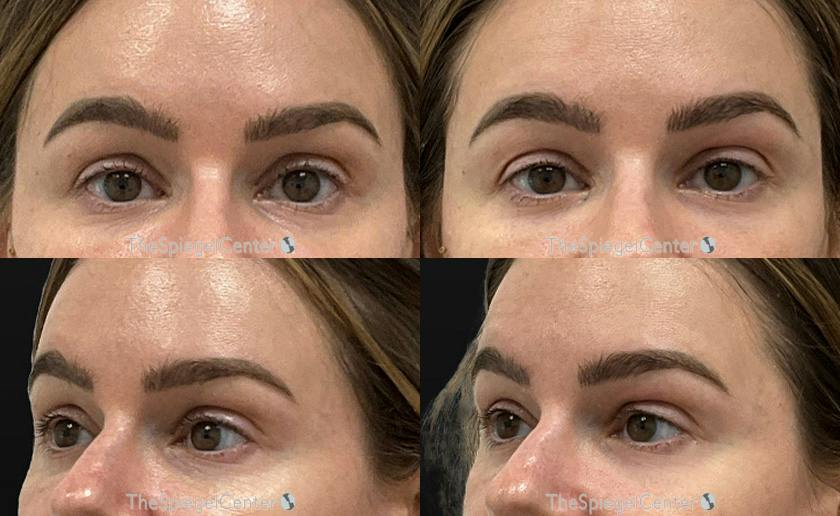 Upper Eyelid Filler Before & After Gallery - Patient 254006 - Image 1