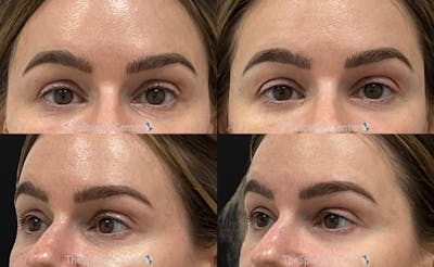 Upper Eyelid Filler Before & After Gallery - Patient 254006 - Image 1