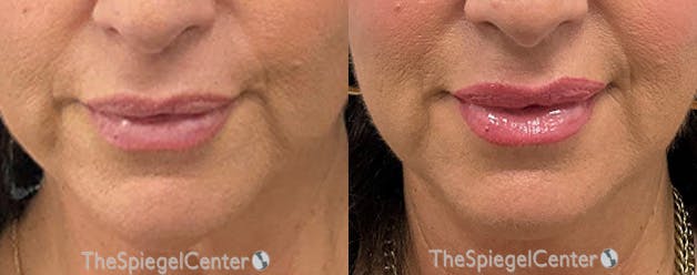 DAO Botulinum Before & After Gallery - Patient 416717 - Image 1