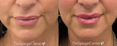 DAO Botulinum Before & After Gallery - Patient 416717 - Image 1
