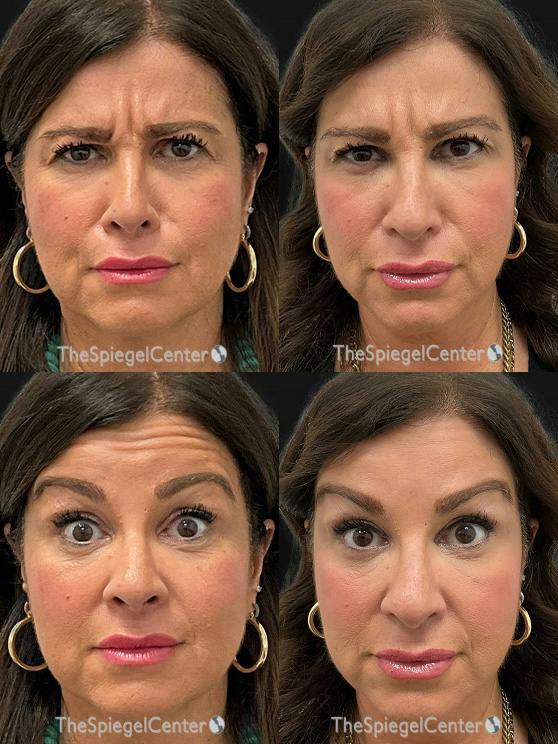 Botox / Dysport / Jeuveau / Xeomin Before & After Gallery - Patient 232974 - Image 1