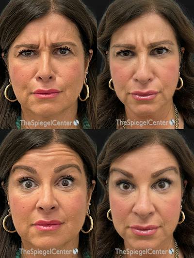Botox / Dysport / Jeuveau / Xeomin Before & After Gallery - Patient 232974 - Image 1