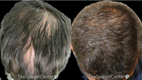 Hair Restoration Before & After Gallery - Patient 199078 - Image 1