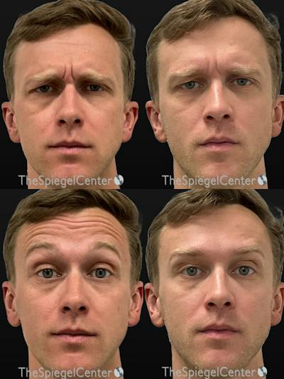 Botox / Dysport / Jeuveau / Xeomin Before & After Gallery - Patient 287904 - Image 1