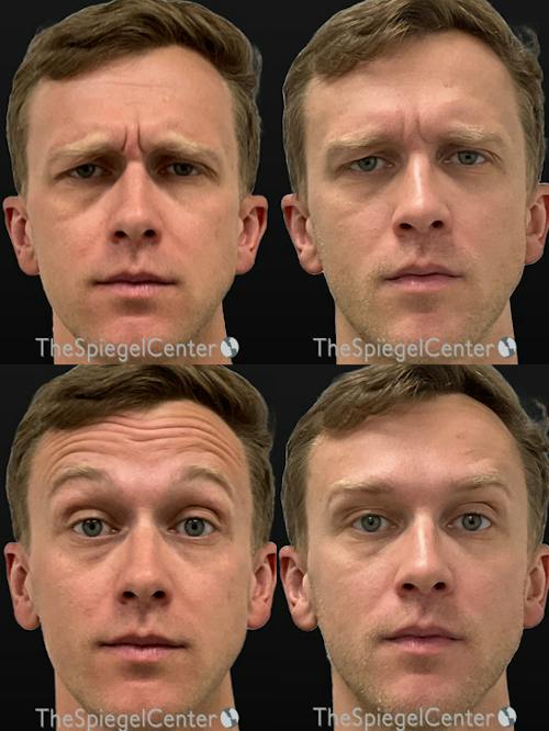 Botox / Dysport / Jeuveau / Xeomin Before & After Gallery - Patient 287904 - Image 1
