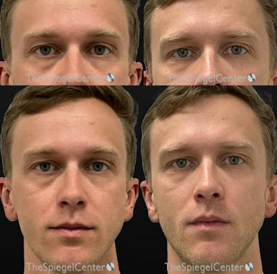 Temple Filler Before & After Gallery - Patient 170603 - Image 1