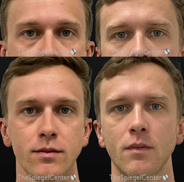 Temple Filler Before & After Gallery - Patient 170603 - Image 1