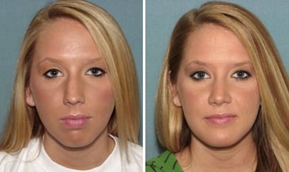 Rhinoplasty Before & After Gallery - Patient 1993295 - Image 1