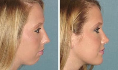 Rhinoplasty Before & After Gallery - Patient 1993295 - Image 1