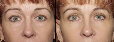 Blepharoplasty Before & After Gallery - Patient 1993305 - Image 1