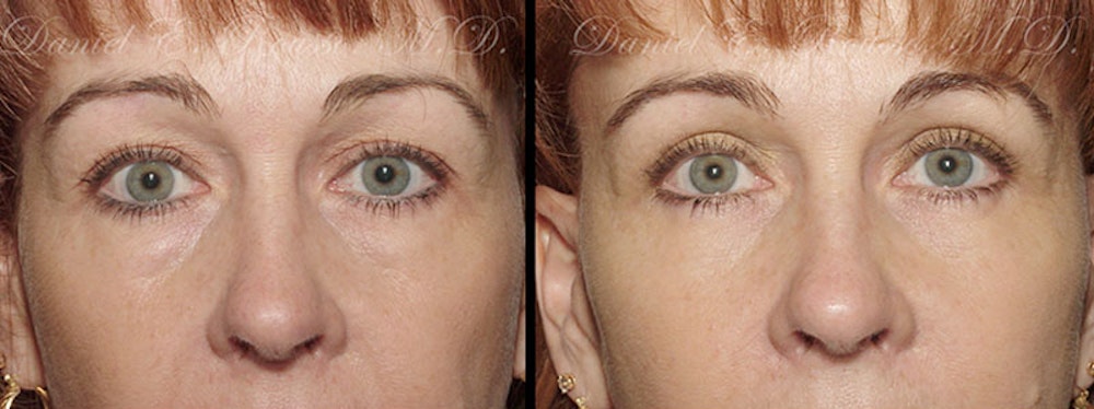 Blepharoplasty Before & After Gallery - Patient 1993305 - Image 1