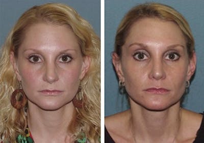 Rhinoplasty <span class=small>By Dr. Daniel Rousso</span> Before & After Gallery - Patient 1993308 - Image 2