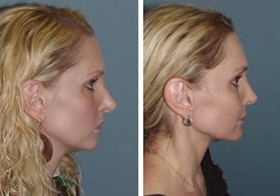 Rhinoplasty Before & After Gallery - Patient 1993308 - Image 1